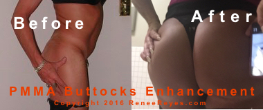 Before After Photo Booty Enlargement